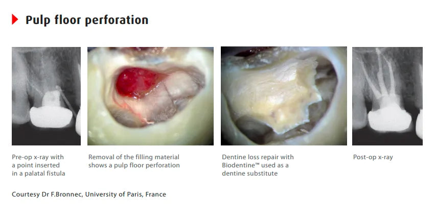 Septodont Biodentine (Single Pouch)